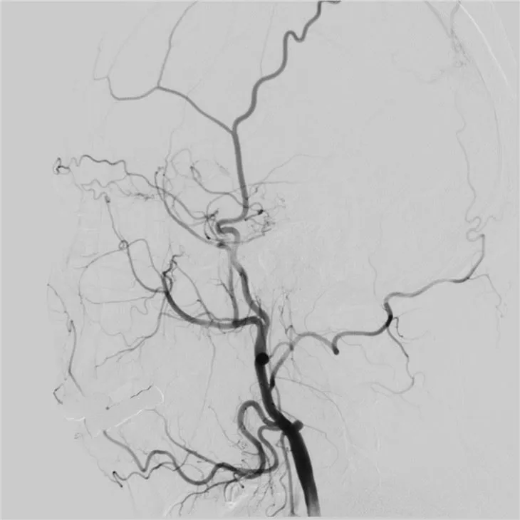 Made-in-China Single Plane Digital Subtraction Angiography Machine