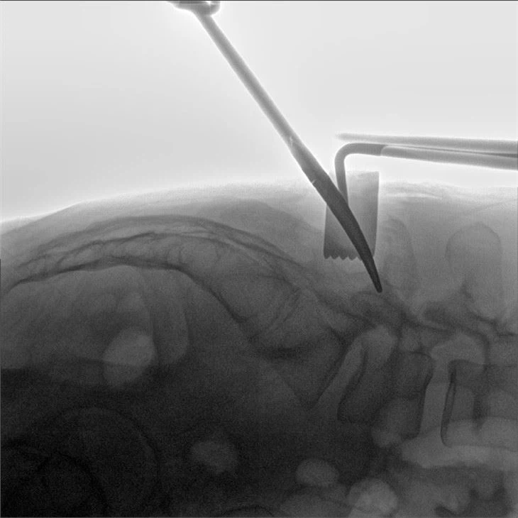 Mobile Orthopedic 3D C Arm Machine