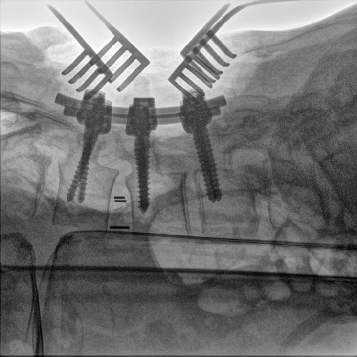 Orthopedic C-arm X-ray Machine