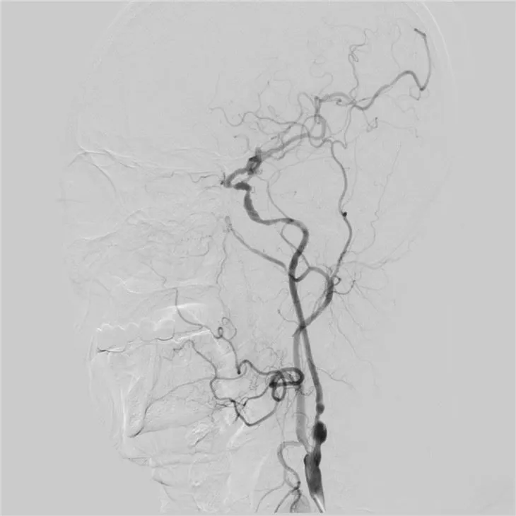 Single Plane Neuro Cath Lab